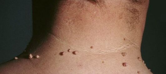 como desfacerse dos papilomas