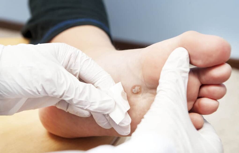 Por que aparecen verrugas no corpo