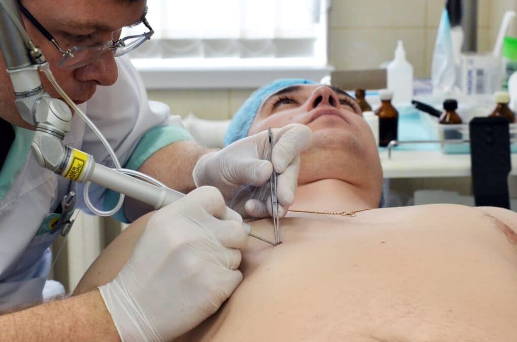 como se librar das verrugas do corpo