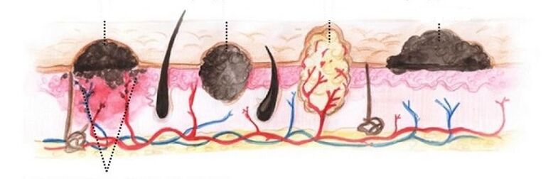 Tipos de papilomas no corpo humano