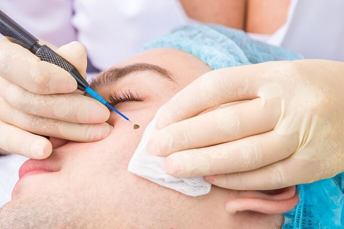 Eliminación de papilomas da cara debido ao virus do papiloma humano